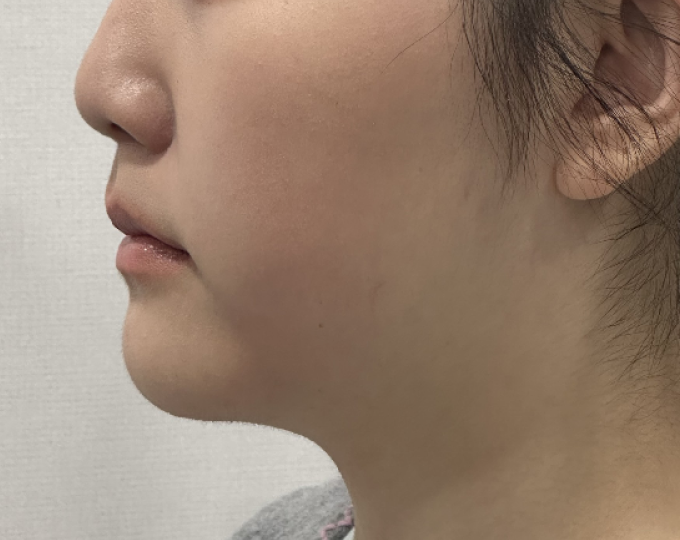 수술 전