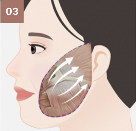 광대뼈수술 과정 3