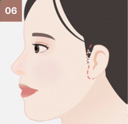 광대뼈수술 과정 4