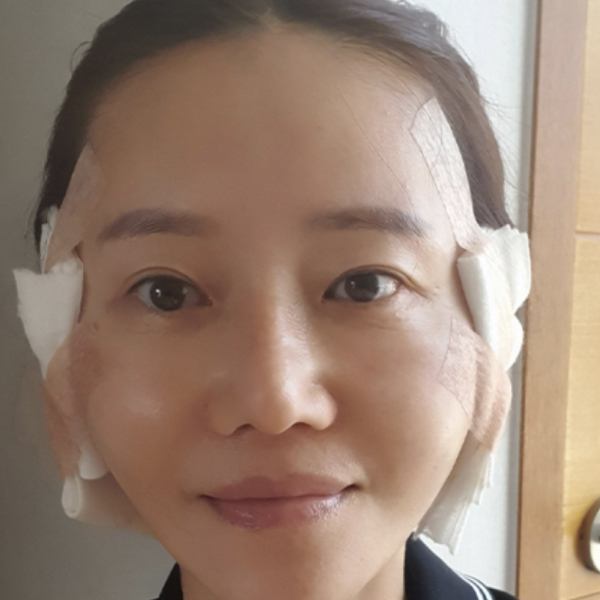 광대뼈수술 과정 1