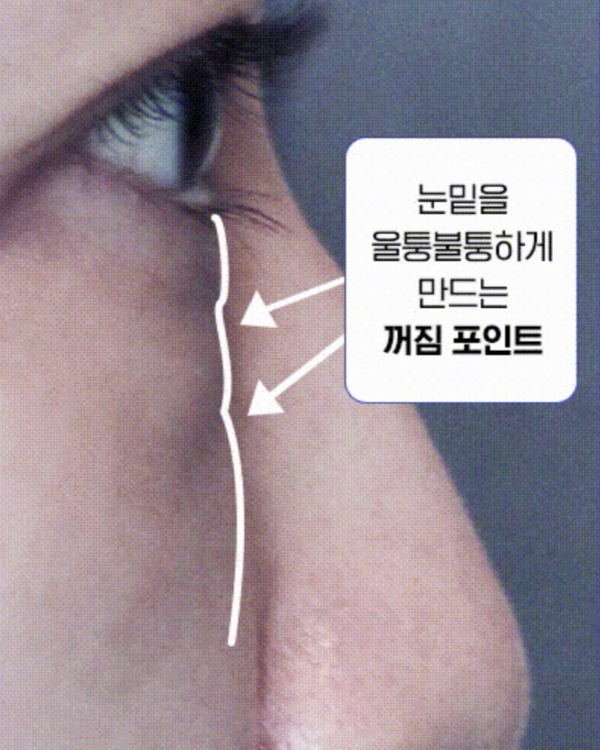 수술 전 눈밑