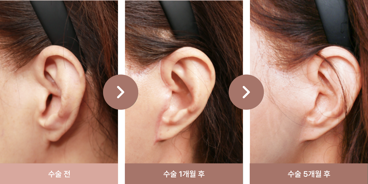 시술부위